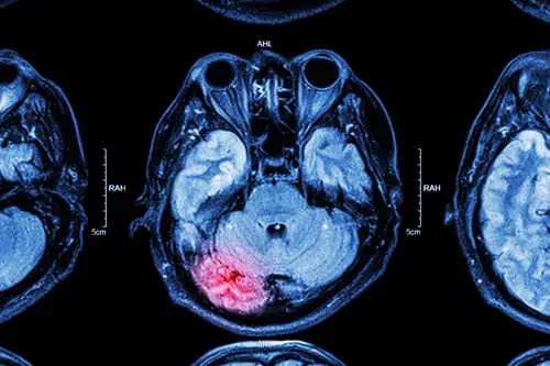 CAT scan of traumatic brain injury