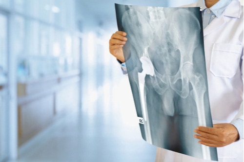 Doctor viewing hip replacement Xrays Exactech Recall Lawsuit concept