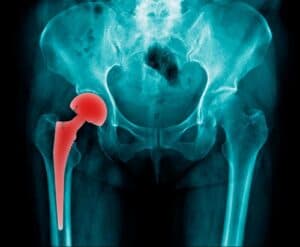Hip x-ray Arkansas hip replacement lawsuit concept